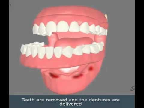 Teeth Extractions For Dentures Russellville KY 42276